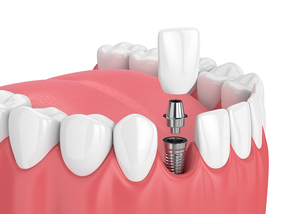 Dental Implants SW Calgary