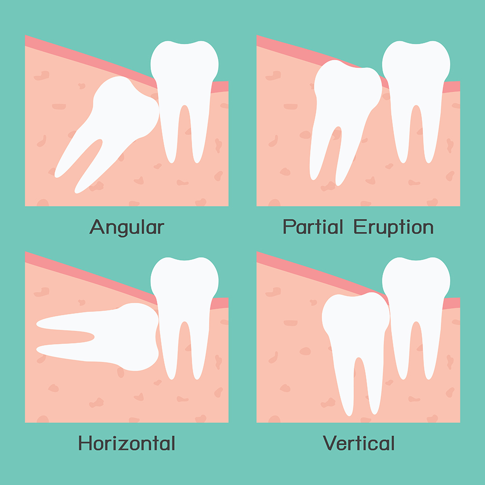 Wisdom Tooth Removal Dentist